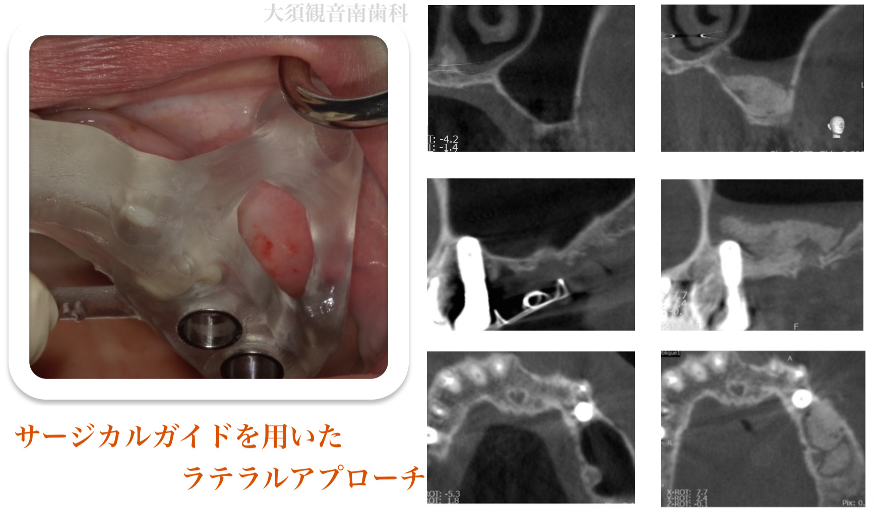 サージカルガイドの写真と上顎のCT画像をまとめたサイナスリフトの症例資料
